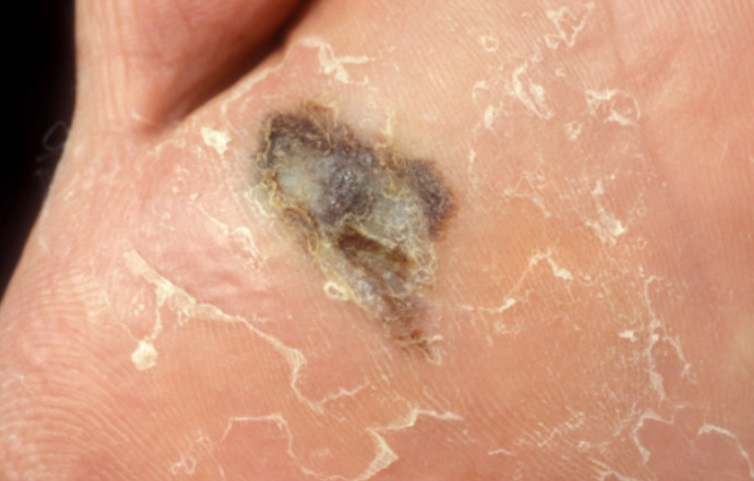 Los podólogos gallegos aconsejan visitas una vez al año para la detección precoz del melanoma en los pies